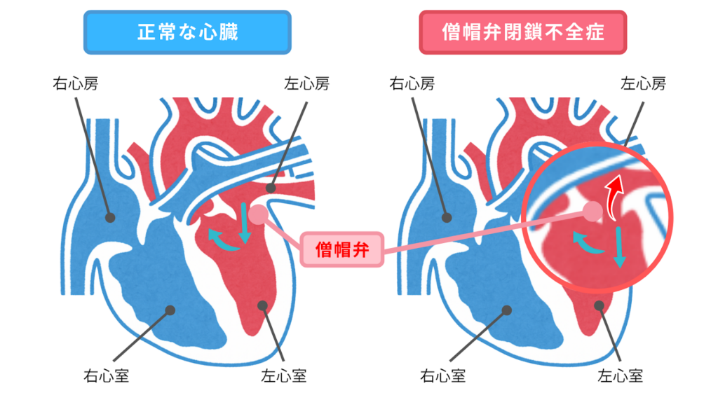 <img src="mitral-regurgitation-dog.png" alt="犬の僧帽弁閉鎖不全症の図解。正常な心臓との比較で、僧帽弁の位置と血液の逆流(矢印)を拡大表示。右心房・右心室・左心房・左心室をラベルで示した飼い主様向けイラスト。">